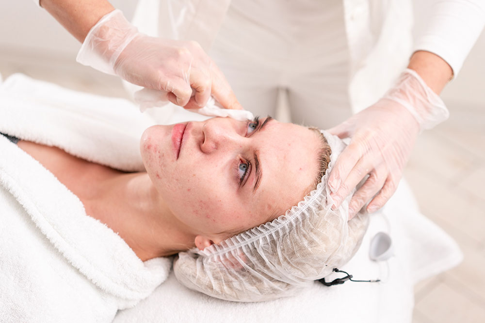 Microdermabrasion for Acne Scars